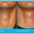 Entreprises 9 image CHIQ CLINIQ INC Hair Removal Services dans Calgary AB