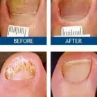 Entreprises 1 image LASER NAIL THERAPY CLINIC--TOENAIL FUNGUS TREATMENT Health & Medicine dans North York ON