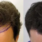 Business 13 image RAHAL HAIR TRANSPLANT TORONTO Health & Medicine in North York ON