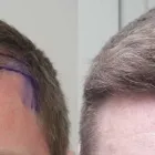 Business 15 image RAHAL HAIR TRANSPLANT TORONTO Health & Medicine in North York ON