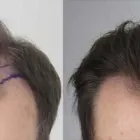 Business 17 image RAHAL HAIR TRANSPLANT TORONTO Health & Medicine in North York ON