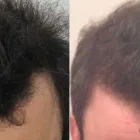 Business 18 image RAHAL HAIR TRANSPLANT TORONTO Health & Medicine in North York ON