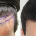 Business 19 image RAHAL HAIR TRANSPLANT TORONTO Health & Medicine in North York ON