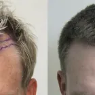 Business 29 image RAHAL HAIR TRANSPLANT TORONTO Health & Medicine in North York ON