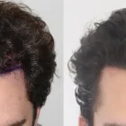 Business 30 image RAHAL HAIR TRANSPLANT TORONTO Health & Medicine in North York ON