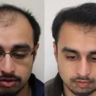 Business 31 image RAHAL HAIR TRANSPLANT TORONTO Health & Medicine in North York ON