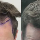 Business 34 image RAHAL HAIR TRANSPLANT TORONTO Health & Medicine in North York ON