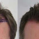 Business 38 image RAHAL HAIR TRANSPLANT TORONTO Health & Medicine in North York ON