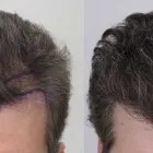 Business 44 image RAHAL HAIR TRANSPLANT TORONTO Health & Medicine in North York ON