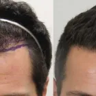 Business 46 image RAHAL HAIR TRANSPLANT TORONTO Health & Medicine in North York ON