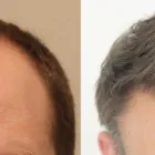 Business 47 image RAHAL HAIR TRANSPLANT TORONTO Health & Medicine in North York ON
