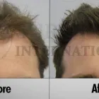 Business 2 image SURE HAIR INTERNATIONAL Hair Loss Treatments & Clinics in Toronto ON