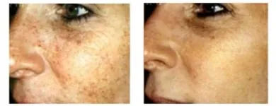 Entreprises 1 image ELECTRA LASER HAIR REMOVAL INC. Tattoos & Body Piercing dans Vancouver BC