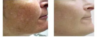 Entreprises 6 image ELECTRA LASER HAIR REMOVAL INC. Tattoos & Body Piercing dans Vancouver BC
