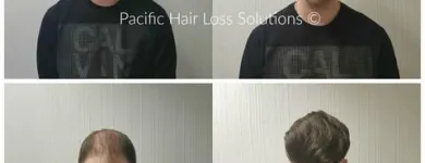 Entreprises 23 image PACIFIC HAIR LOSS SOLUTIONS Wigs & Hairpieces dans Vancouver BC