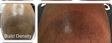 Business 11 image SCALP MICROPIGMENTATION TRAINING CENTER Health & Medicine in Toronto ON