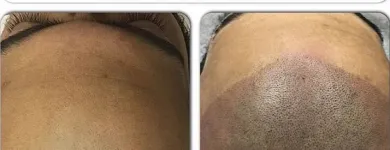 Business 17 image SCALP MICROPIGMENTATION TRAINING CENTER Health & Medicine in Toronto ON