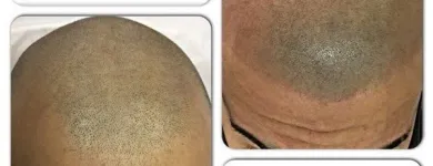 Business 19 image SCALP MICROPIGMENTATION TRAINING CENTER Health & Medicine in Toronto ON