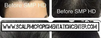 Business 5 image SCALP MICROPIGMENTATION TRAINING CENTER Health & Medicine in Toronto ON