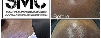 Business 22 image SCALP MICROPIGMENTATION TRAINING CENTER Health & Medicine in Toronto ON