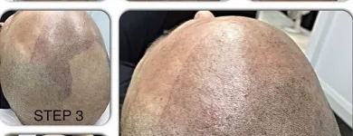 Business 23 image SCALP MICROPIGMENTATION TRAINING CENTER Health & Medicine in Toronto ON