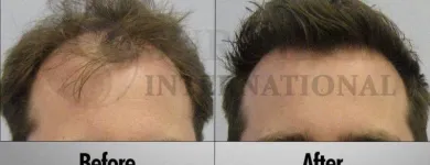 Business 2 image SURE HAIR INTERNATIONAL Hair Loss Treatments & Clinics in Toronto ON