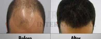 Business 4 image SURE HAIR INTERNATIONAL Hair Loss Treatments & Clinics in Toronto ON