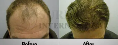 Business 11 image SURE HAIR INTERNATIONAL Hair Loss Treatments & Clinics in Toronto ON